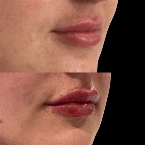 Filler Dissolving • Ciao Bella Aesthetics