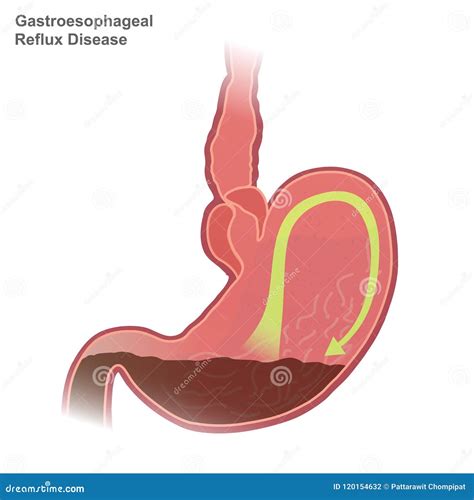 Gastroesophageal Reflux Disease Vector Illustration | CartoonDealer.com #235899824