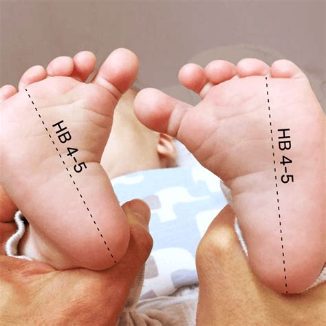 UNFO- Revolutionary Treatment for Metatarsus Adductus