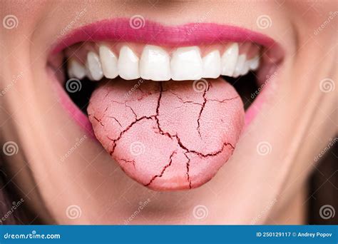 Dry Tongue Pain and Cracks stock image. Image of disease - 250129117