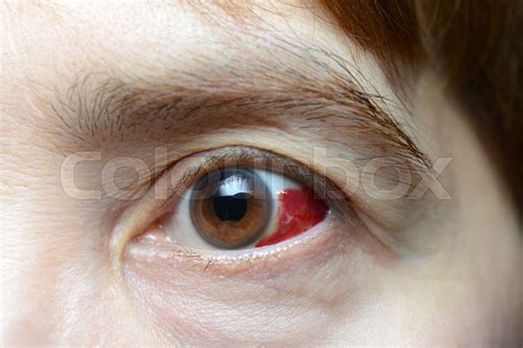Woman with burst blood vessel in eye | Stock image | Colourbox