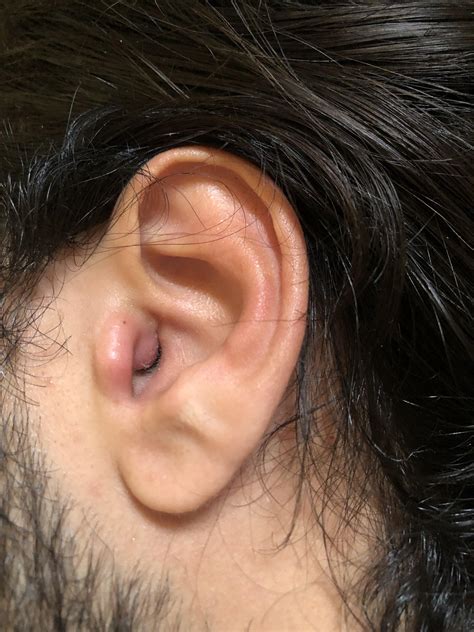 Sebaceous Cyst Ear at Maureen Baker blog
