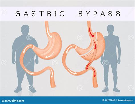 Before and after Gastric Bypass Surgery Stock Illustration - Illustration of care, diet: 78221840