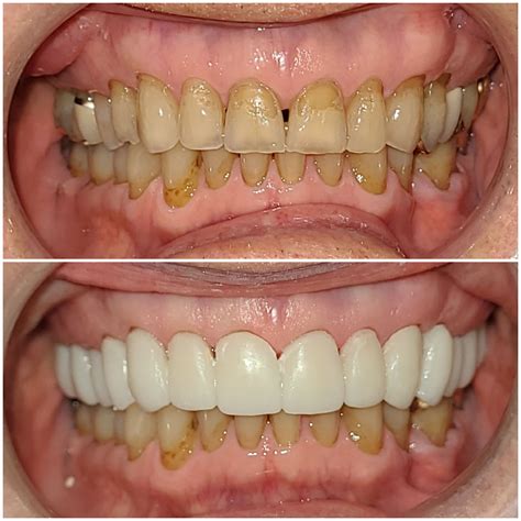 Before & After Gallery: Transformations with Dental Procedures - Arizona Dental Specialists