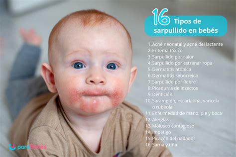 16 Tipos de Sarpullidos en bebés, causas y tratamiento