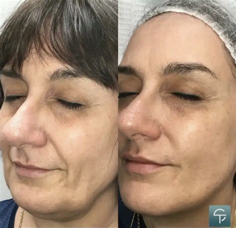 Fotona 4D Lift | Laser Skin Tightening | Skintellect