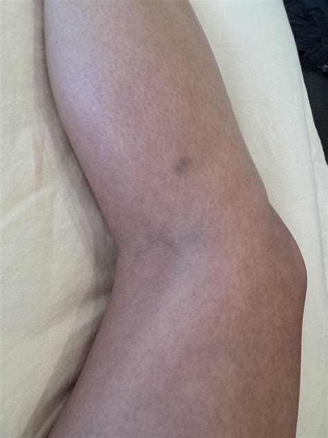 What could these blue bruise-like blotches behind my (swollen) knees be? : r/Autoimmune