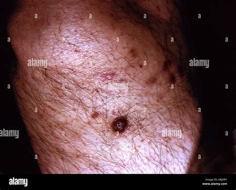 Kaposi Sarkom Läsionen am Bein des Patienten Stockfotografie - Alamy