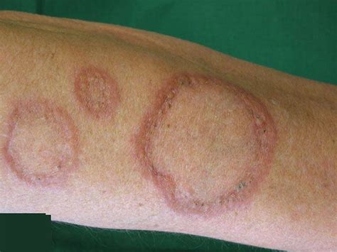 Granuloma Annulare - Causes, Rash, Treatment