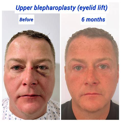 How Long Does Swelling Last After Eyelid Surgery? - Harley Clinic