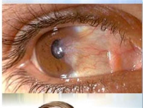 Factores ambientales pueden desencadenar carnosidades en los ojos ...