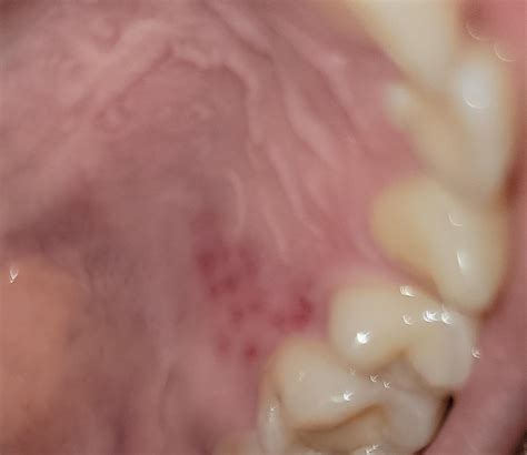 What's up with these sore red dots on the roof of my mouth? : r/askdentists