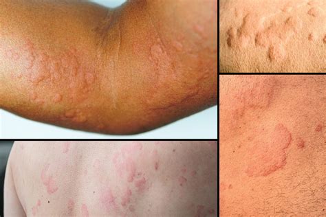 Surprising Causes Of Hives Revealed — What May Be Triggering Your Skin ...