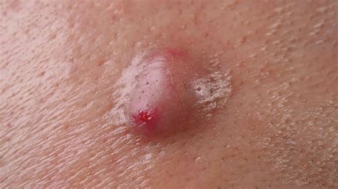 Resección de Quistes | Especialistas en la Piel