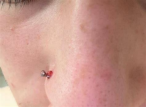 Piercing Bump Or Keloid : r/piercing