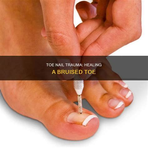 Toe Nail Trauma: Healing A Bruised Toe | Nailicy