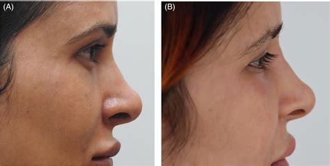 Delayed hypersensitivity reaction to hyaluronic acid dermal filler post ...