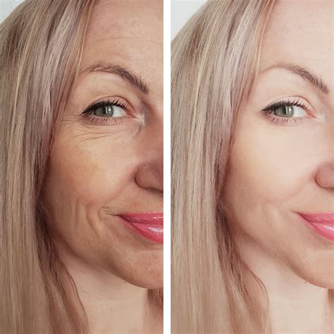 "Ozempic Face" Nedir ve Nasıl Önlenir? - La Rachel-Paris