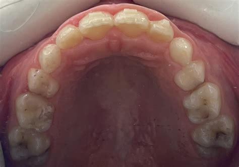 Case Gallery - ClearCorrect