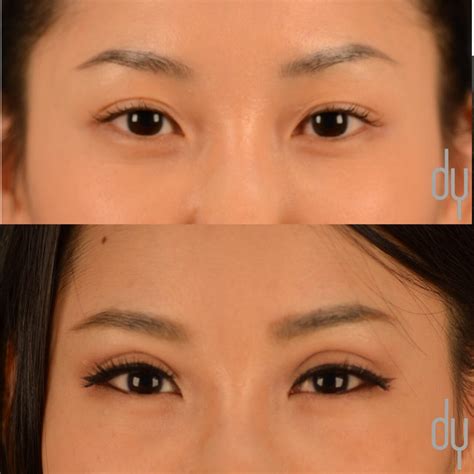 Asian Eyelid Surgery | Asian Blepharoplasty - Beverly Hills Facial Plastic Surgery - Donald B ...