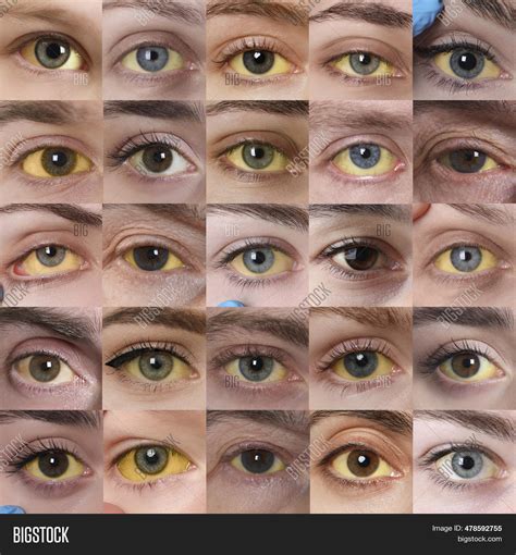 Yellowing Eyes Symptom Image & Photo (Free Trial) | Bigstock