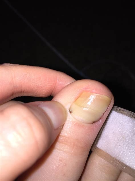 What is going on with my toe?? Black spots by cuticle, yellow nail : r/NailFungus