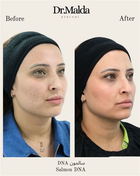 Salmon DNA Injections for Skin Rejuvenation | Dr Malda