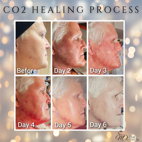 CO2 Laser Resurfacing: What’s the Cost for Under Eyes? — MD Body & Med Spa