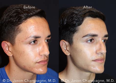 Eyebrow Hair Transplantation Gallery | Beverly Hills Plastic Surgeon - Dr. Jason Champagne