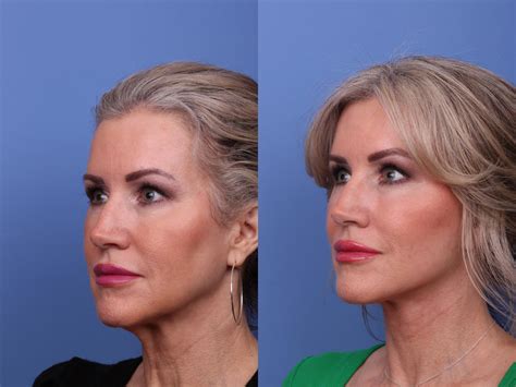 Facelift Before and After Pictures Case 564 | Scottsdale & Phoenix, AZ | Hobgood Facial Plastic ...