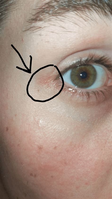 Red Under Baby's Eyes