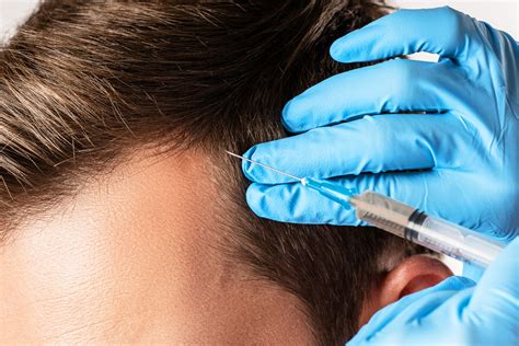 How To Fix A Messed Up Hairline - Wimpole Clinic