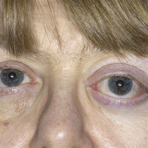 Are you having a bulge eye? Do monthly checkups - JPG Opticals