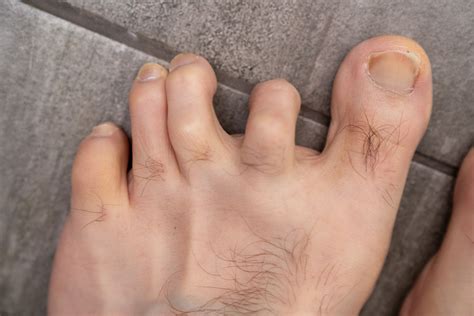 Hammer toe surgery - gulugod