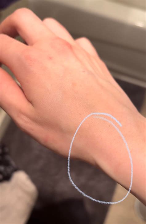 Painful bulging wrist vein : r/carpaltunnel