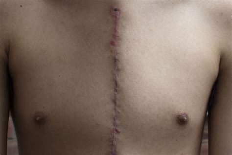 After open heart surgery, the sternum is a fractured bone. Is it treat ...