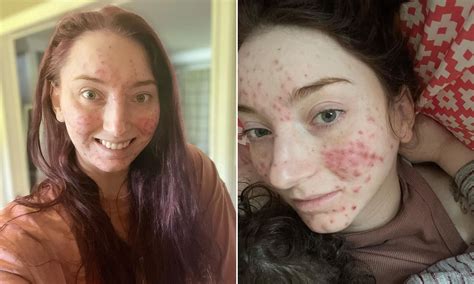 What Is Skin Picking Disorder Called at Melody Hanks blog
