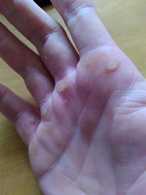 Any clue as to what these callus-like bumps (top right and pinkie finger - middle is a torn ...