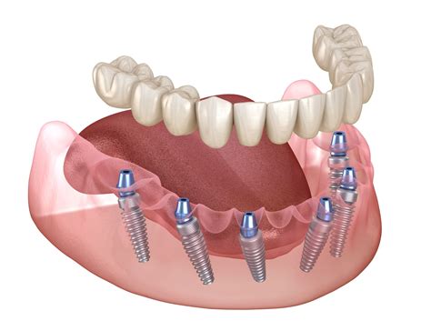 Complete Dental Implants