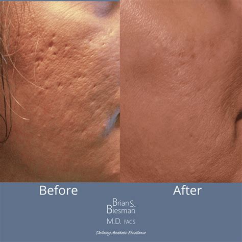 Fraxel Acne Scars Before And After Laser Treatment Acne Scars NYC