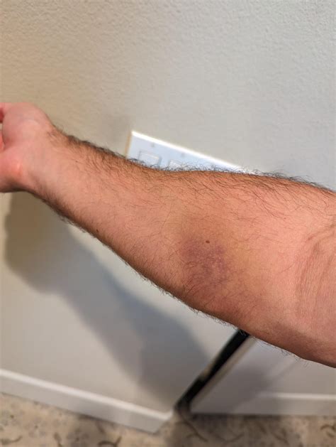 Bruise 5 days after blood draw ? : r/phlebotomy