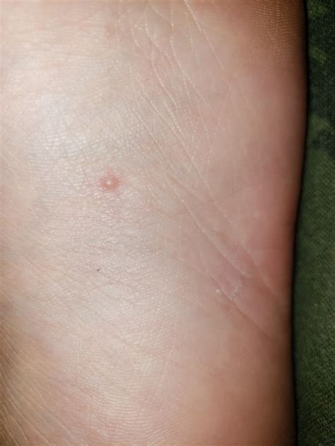 Itchy Bump On Foot at Ana Means blog