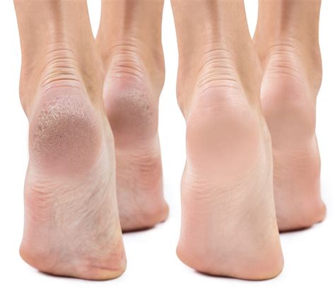 Dry Feet & Cracked Heels: Causes & Treatment - Foot and Ankle Group