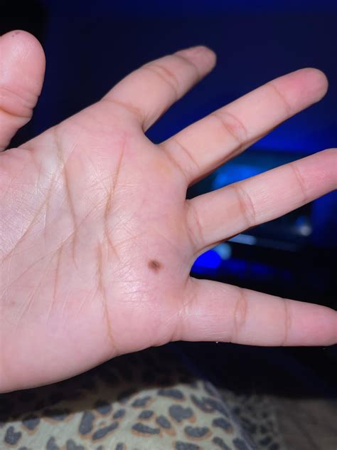 4 different moles on the cuticles of my fingers : r/Melanoma