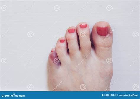 Foot with Broken Pinky Toe. Stock Image - Image of foot, affected: 288600623
