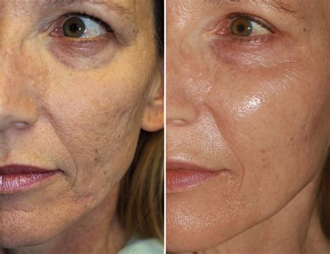 #1 Microneedling Scottsdale Med Spa - Restore Youthful Skin!