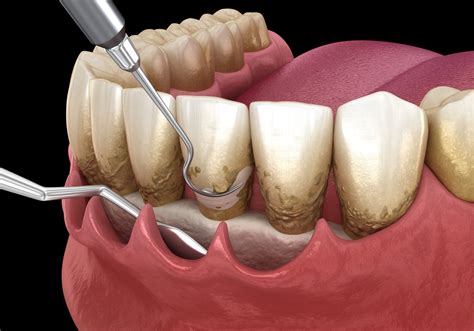 Periodontal Treatment Newtown | Dr. Patel Yardley Dental Arts