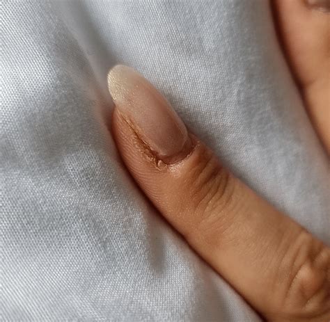 deep callus on finger cuticle keeps cracking : r/skin