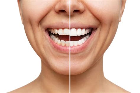 What Do Porcelain Veneers Cost With Insurance? (2024 Update)