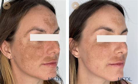 Hyperpigmentation and Melasma — Hunter Coast Dermatology & Laser | Newcastle Dermatologists